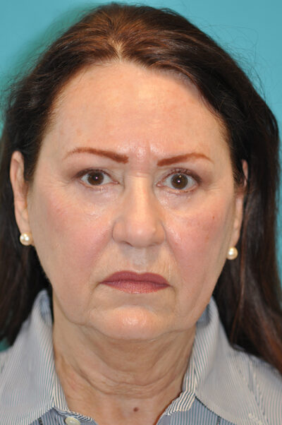 Facelift and Necklift Before and After Photos Case 9213 Before Photo Facelift and Necklift Before and After Photos