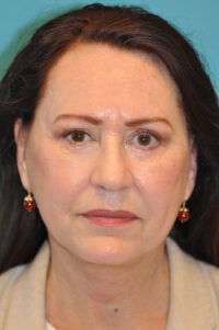 Facelift and Necklift Before and After Photos