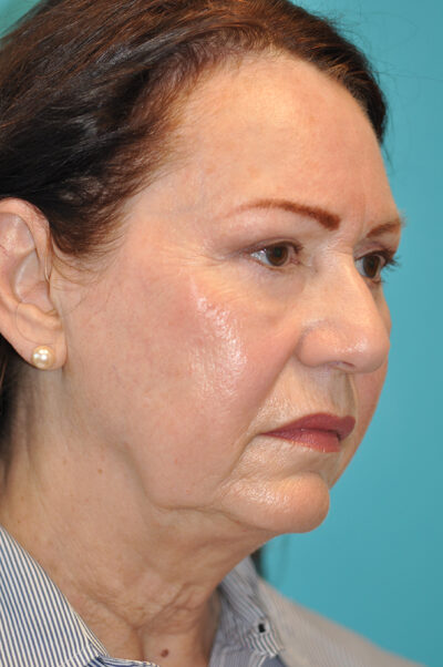 Facelift and Necklift Before and After Photos Case 9213 Before Photo Facelift and Necklift Before and After Photos