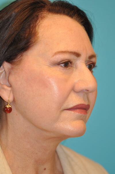 Facelift and Necklift Before and After Photos Case 9213 After Photo Facelift and Necklift Before and After Photos