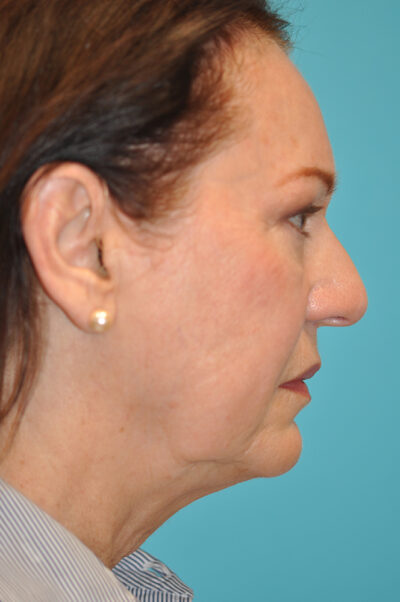 Facelift and Necklift Before and After Photos Case 9213 Before Photo Facelift and Necklift Before and After Photos