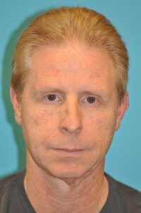 Facelift and Necklift Before and After Photos