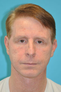Facelift and Necklift Before and After Photos
