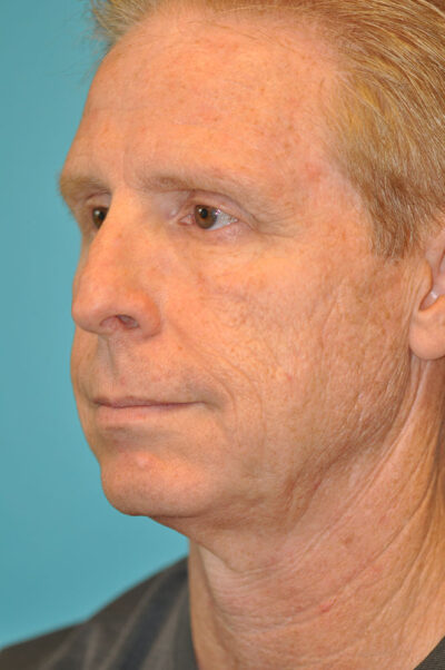 Facelift and Necklift Before and After Photos Case 10573 Before Photo Facelift and Necklift Before and After Photos