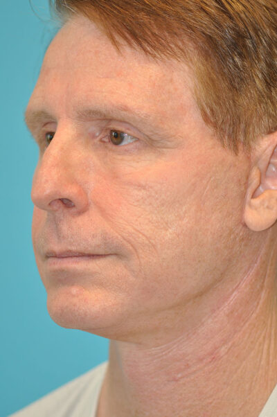 Facelift and Necklift Before and After Photos Case 10573 After Photo Facelift and Necklift Before and After Photos