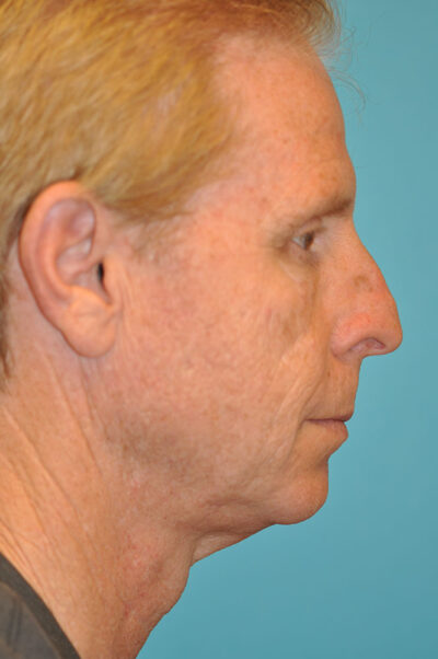 Facelift and Necklift Before and After Photos Case 10573 Before Photo Facelift and Necklift Before and After Photos