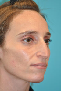 Rhinoplasty (Nose Job) Before and After Photos