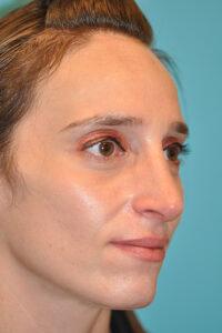 Rhinoplasty (Nose Job) Before and After Photos