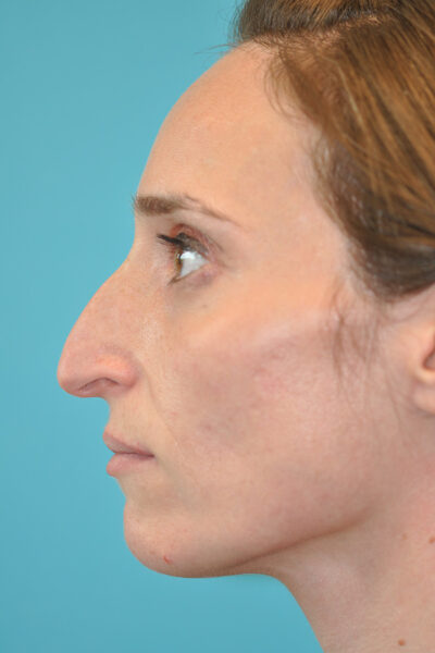Rhinoplasty (Nose Job) Before and After Photos