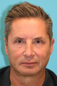 Upper Blepharoplasty (Eyelid) Before and After Photos