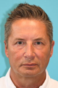 Upper Blepharoplasty (Eyelid) Before and After Photos