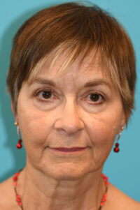 Upper Blepharoplasty (Eyelid) Before and After Photos