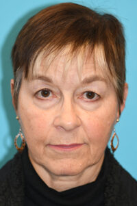 Upper Blepharoplasty (Eyelid) Before and After Photos