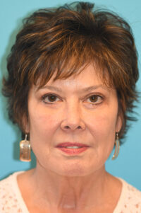 Upper Blepharoplasty (Eyelid) Before and After Photos