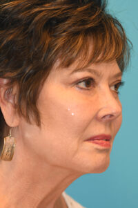 Upper Blepharoplasty (Eyelid) Before and After Photos