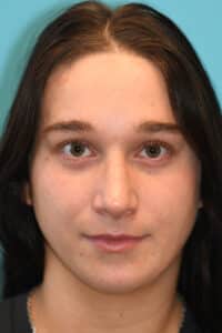 Rhinoplasty (Nose Job) Before and After Photos