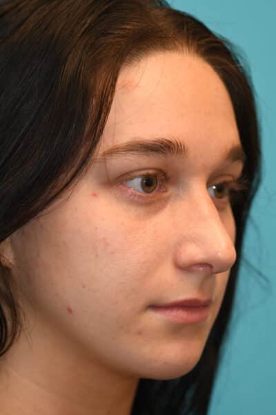 Rhinoplasty (Nose Job) Before and After Photos