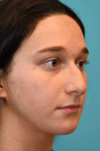 Rhinoplasty (Nose Job) Before and After Photos