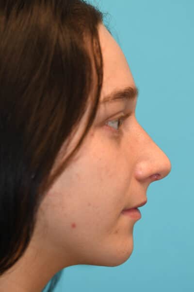 Rhinoplasty (Nose Job) Before and After Photos
