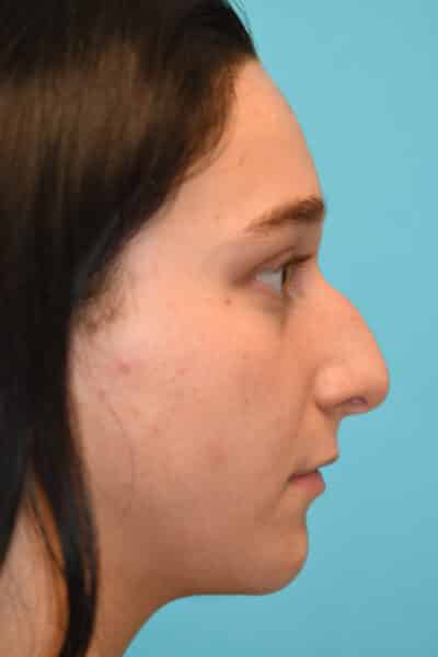 Rhinoplasty (Nose Job) Before and After Photos