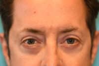 Upper Blepharoplasty (Eyelid) Before and After Photos