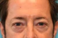 Upper Blepharoplasty (Eyelid) Before and After Photos