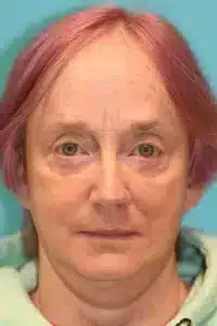 Skin Cancer Reconstruction Before and After Photos