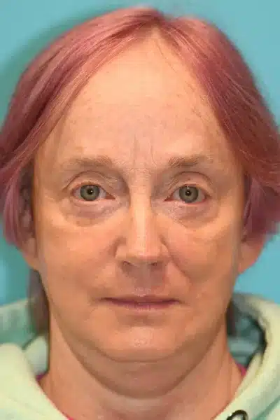 Skin Cancer Reconstruction Before and After Photos