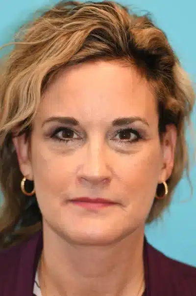 Facelift and Necklift Before and After Photos