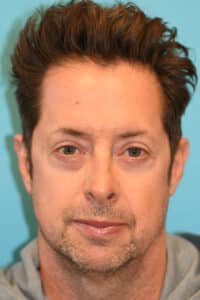 Upper Blepharoplasty (Eyelid) Before and After Photos