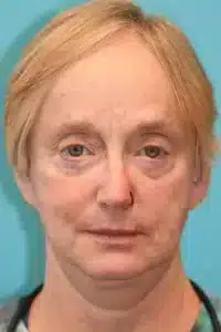 Skin Cancer Reconstruction Before and After Photos