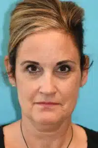 Facelift and Necklift Before and After Photos