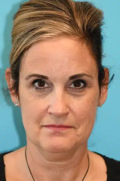 Facelift and Necklift Before and After Photos