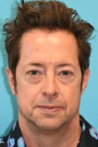 Upper Blepharoplasty (Eyelid) Before and After Photos