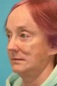 Skin Cancer Reconstruction Before and After Photos