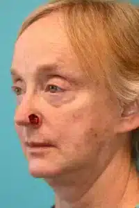 Skin Cancer Reconstruction Before and After Photos
