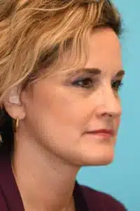 Facelift and Necklift Before and After Photos