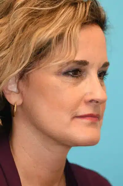 Facelift and Necklift Before and After Photos