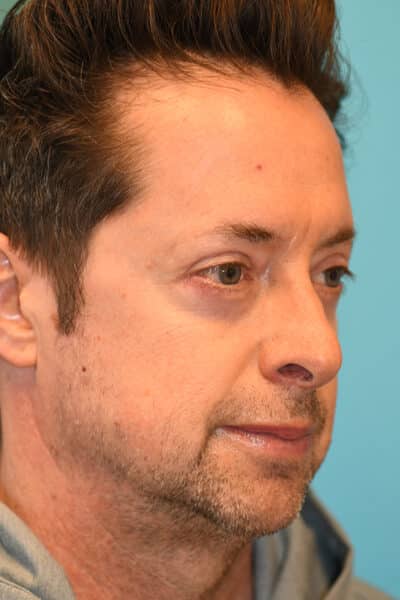 Upper Blepharoplasty (Eyelid) Before and After Photos