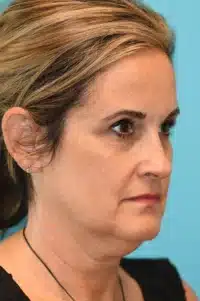 Facelift and Necklift Before and After Photos