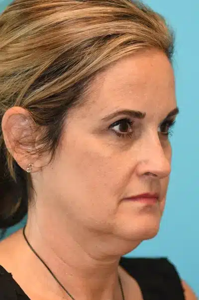 Facelift and Necklift Before and After Photos