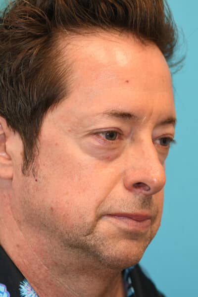 Lower Blepharoplasty (Eyelid) Before and After Photos