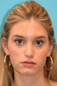 Rhinoplasty (Nose Job) Before and After Photos