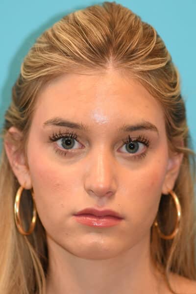 Rhinoplasty (Nose Job) Before and After Photos