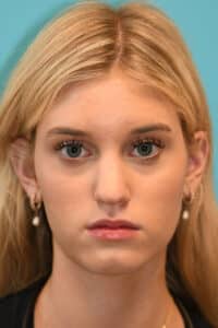 Rhinoplasty (Nose Job) Before and After Photos
