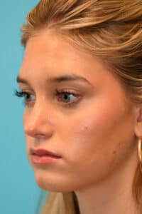 Rhinoplasty (Nose Job) Before and After Photos