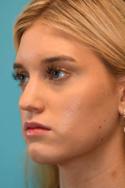 Rhinoplasty (Nose Job) Before and After Photos