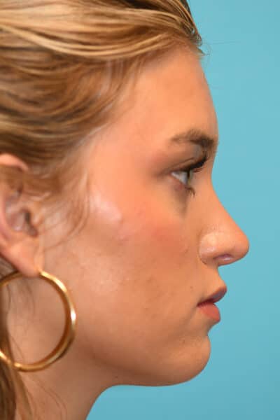 Rhinoplasty (Nose Job) Before and After Photos