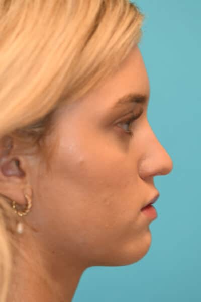 Rhinoplasty (Nose Job) Before and After Photos
