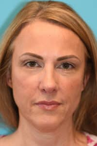 Rhinoplasty (Nose Job) Before and After Photos